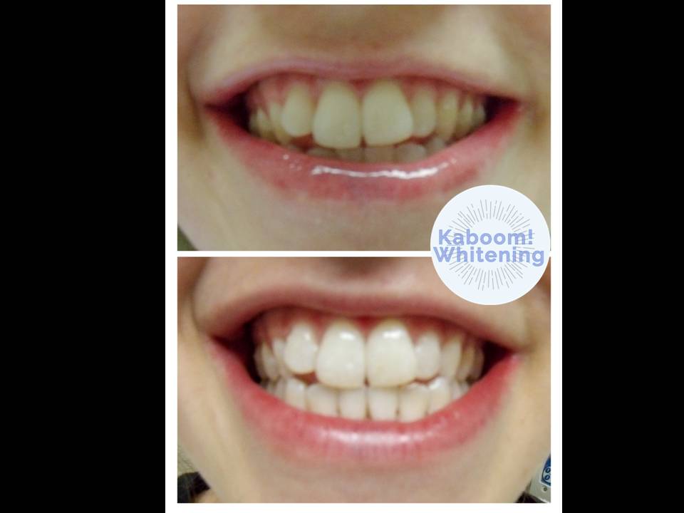 teeth whitening Kaboom