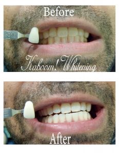 Before_and_after_teeth_whitening_images