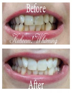 Teeth-Whitening-Before-after-pic